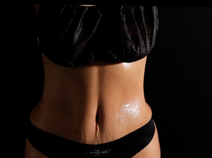 Tummy Tuck Before & After Patient #5144