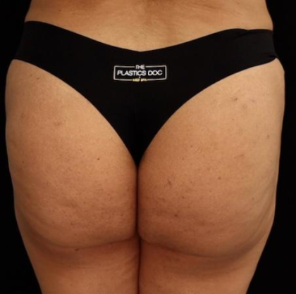 alloClae Before & After Patient #5086