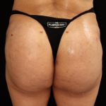 alloClae Before & After Patient #5086