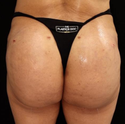 alloClae Before & After Patient #5086