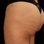 alloClae Before & After Patient #5086