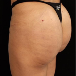 alloClae Before & After Patient #5086
