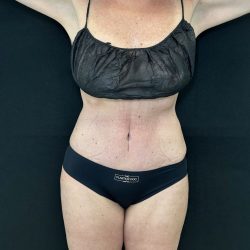 Tummy Tuck Before & After Patient #5082