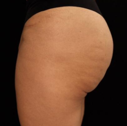 alloClae Before & After Patient #5086