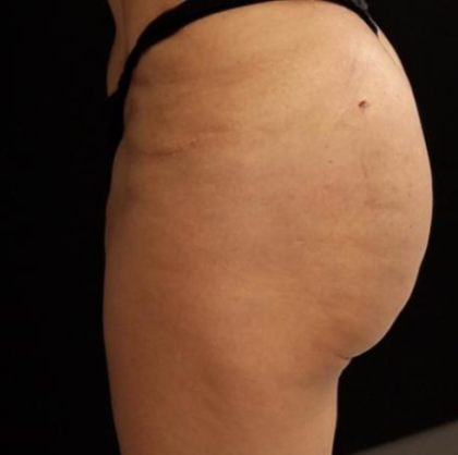 alloClae Before & After Patient #5086