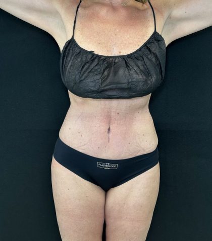 Tummy Tuck Before & After Patient #5082