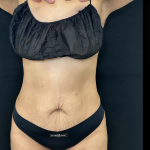 Tummy Tuck Before & After Patient #5144