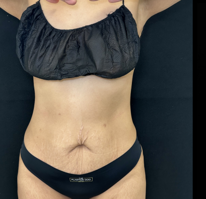 Tummy Tuck Before & After Patient #5144