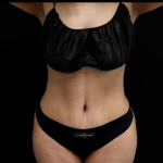 Tummy Tuck Before & After Patient #5144