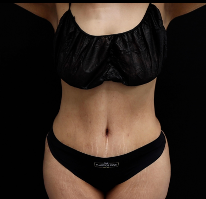 Tummy Tuck Before & After Patient #5144