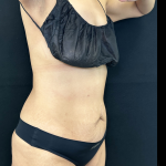 Tummy Tuck Before & After Patient #5144