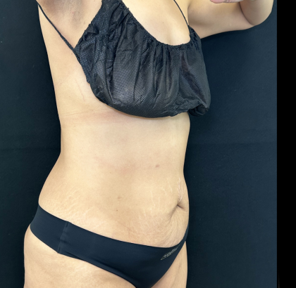 Tummy Tuck Before & After Patient #5144