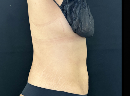 Tummy Tuck Before & After Patient #5144