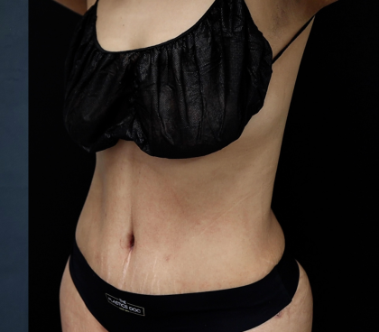 Tummy Tuck Before & After Patient #5144