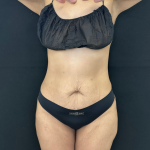 Tummy Tuck Before & After Patient #5242