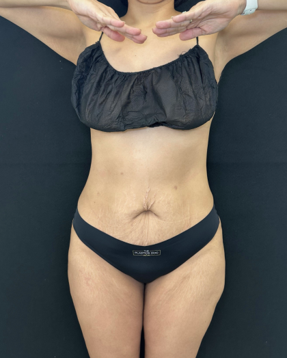 Tummy Tuck Before & After Patient #5242