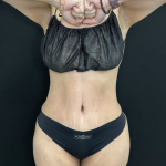 Tummy Tuck Before & After Patient #5242