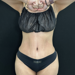 Tummy Tuck Before & After Patient #5242