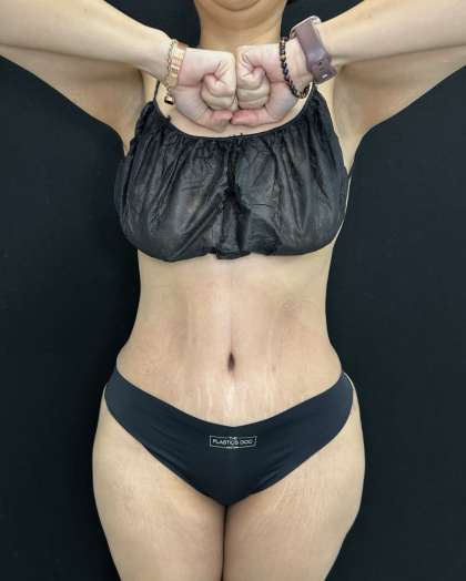 Tummy Tuck Before & After Patient #5242