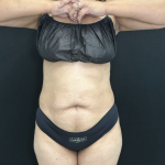 Tummy Tuck Before & After Patient #5243