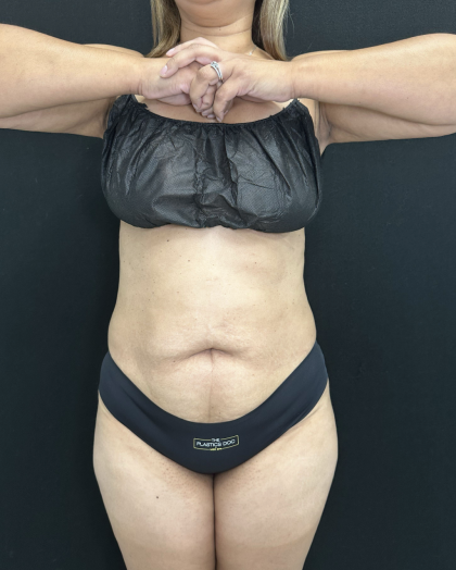 Tummy Tuck Before & After Patient #5243
