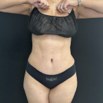 Tummy Tuck Before & After Patient #5243