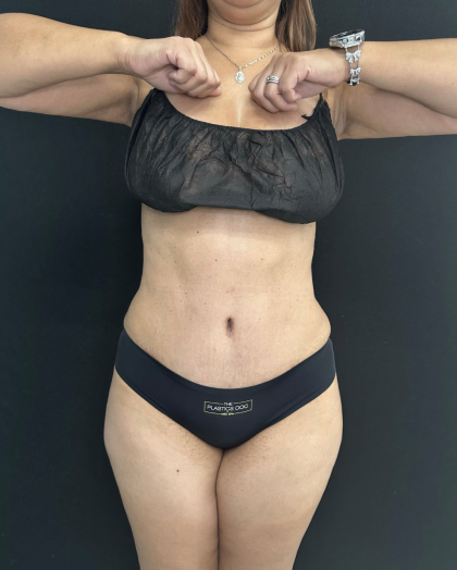 Tummy Tuck Before & After Patient #5243