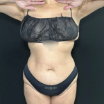 Tummy Tuck Before & After Patient #5244