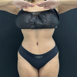 Tummy Tuck Before & After Patient #5244