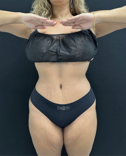 Tummy Tuck Before & After Patient #5244