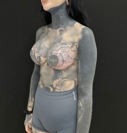 Breast Augmentation Before & After Patient #5233