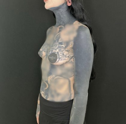 Breast Augmentation Before & After Patient #5233
