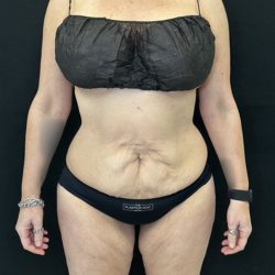 Tummy Tuck Before & After Patient #5335