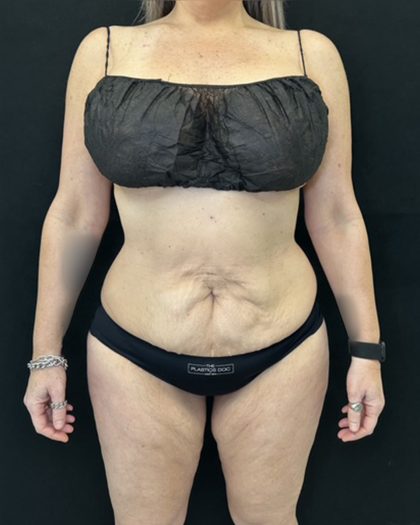 Tummy Tuck Before & After Patient #5335