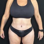 Tummy Tuck Before & After Patient #5335