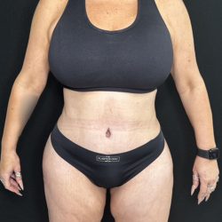 Tummy Tuck Before & After Patient #5335