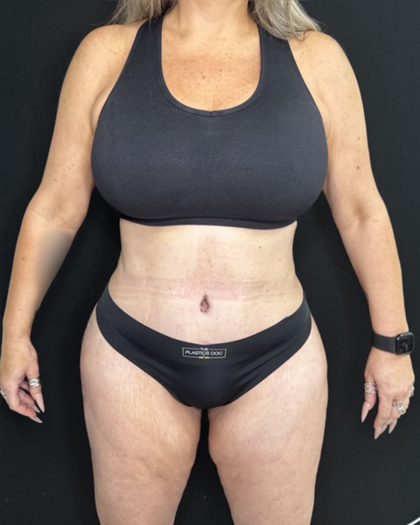 Tummy Tuck Before & After Patient #5335