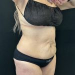 Tummy Tuck Before & After Patient #5344