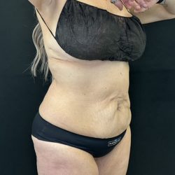 Tummy Tuck Before & After Patient #5344