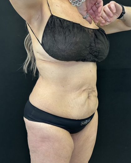 Tummy Tuck Before & After Patient #5344