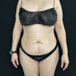 Tummy Tuck Before & After Patient #5336