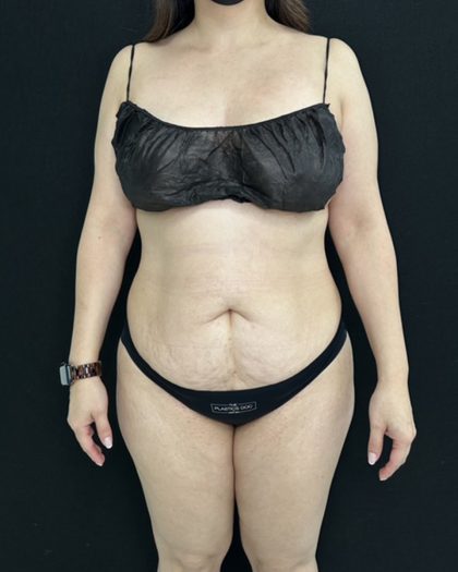 Tummy Tuck Before & After Patient #5336
