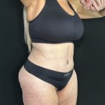 Tummy Tuck Before & After Patient #5344