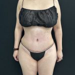 Tummy Tuck Before & After Patient #5336