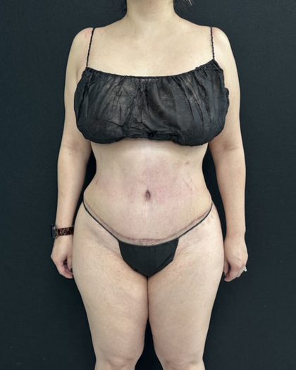 Tummy Tuck Before & After Patient #5336