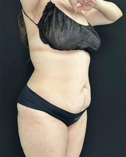 Tummy Tuck Before & After Patient #5336