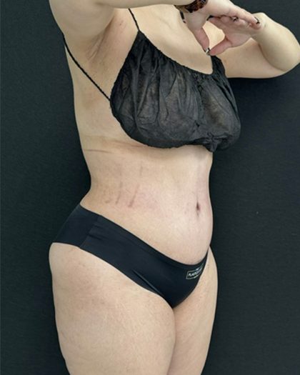 Tummy Tuck Before & After Patient #5336