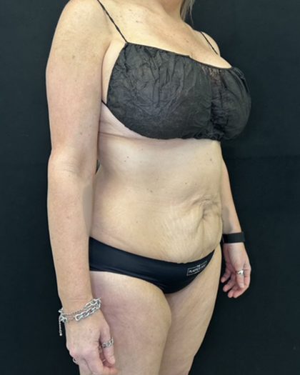 Tummy Tuck Before & After Patient #5344