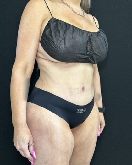 Tummy Tuck Before & After Patient #5344