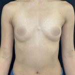 Preservé Breast Augmentation Before & After Patient #5318
